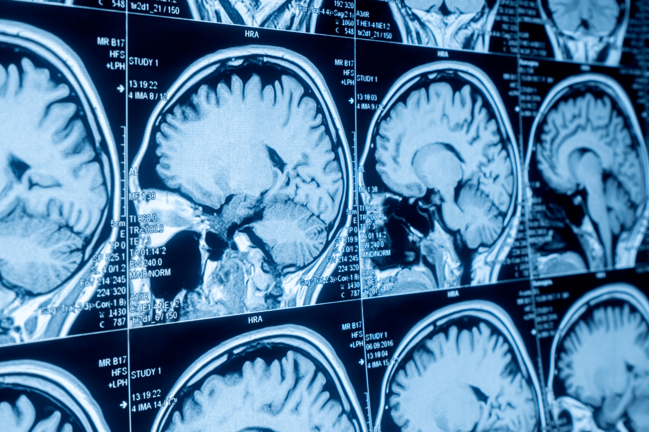 How to Treat AVM: Arteriovenous Malformations (AVMs)