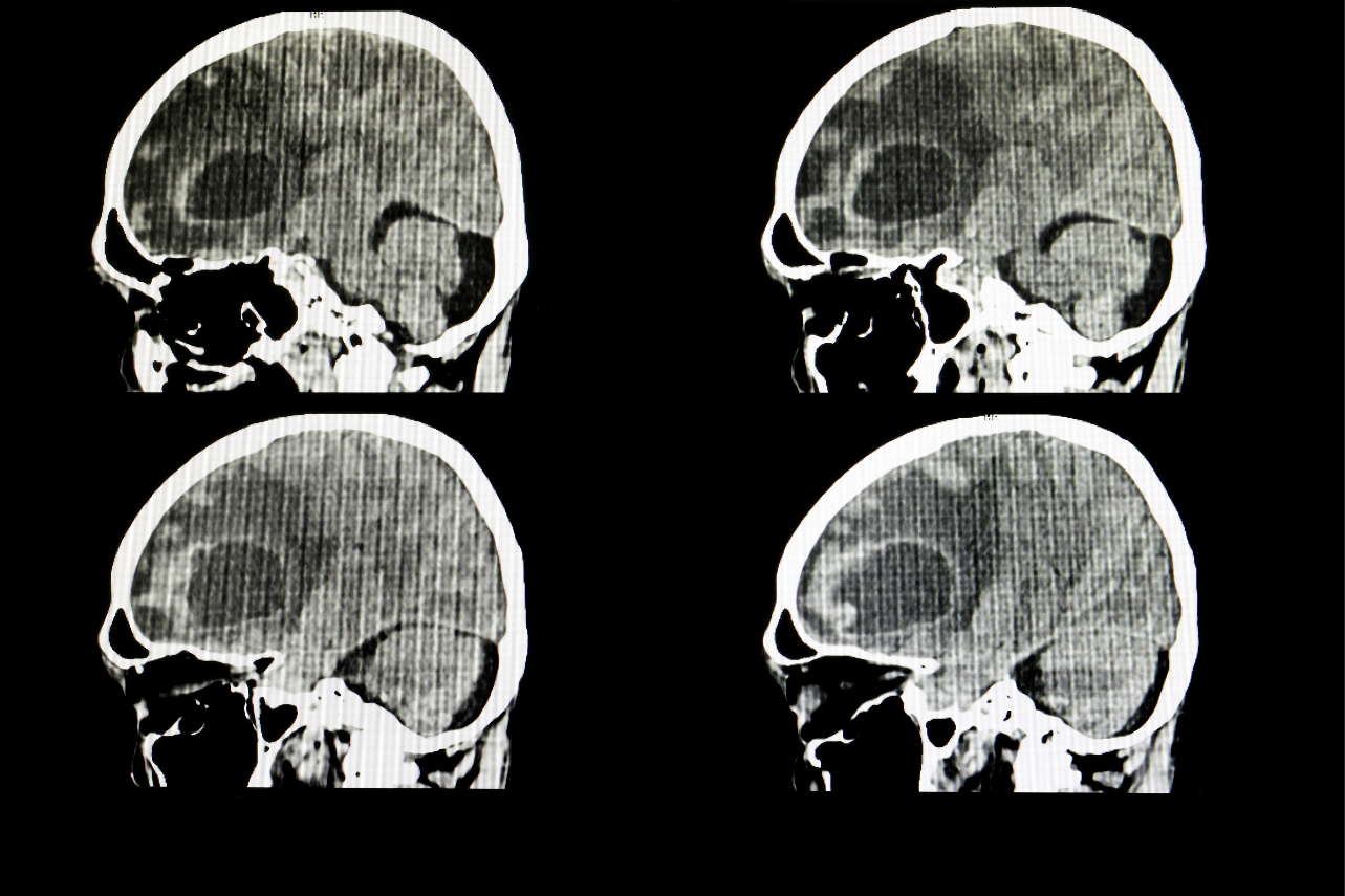 How to Treat Metastatic Tumors