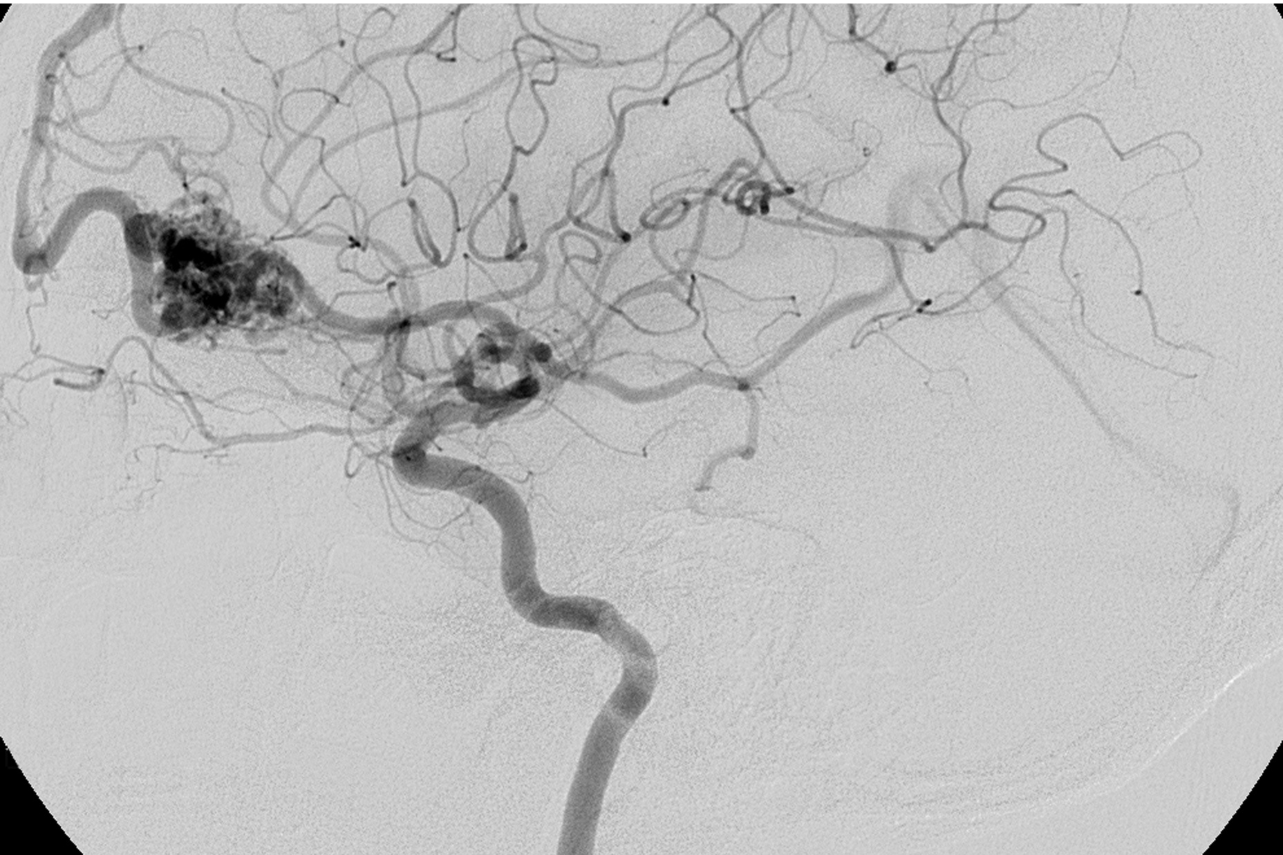 How Does Gamma Knife®️ Treatment for Brain Tumors Work?